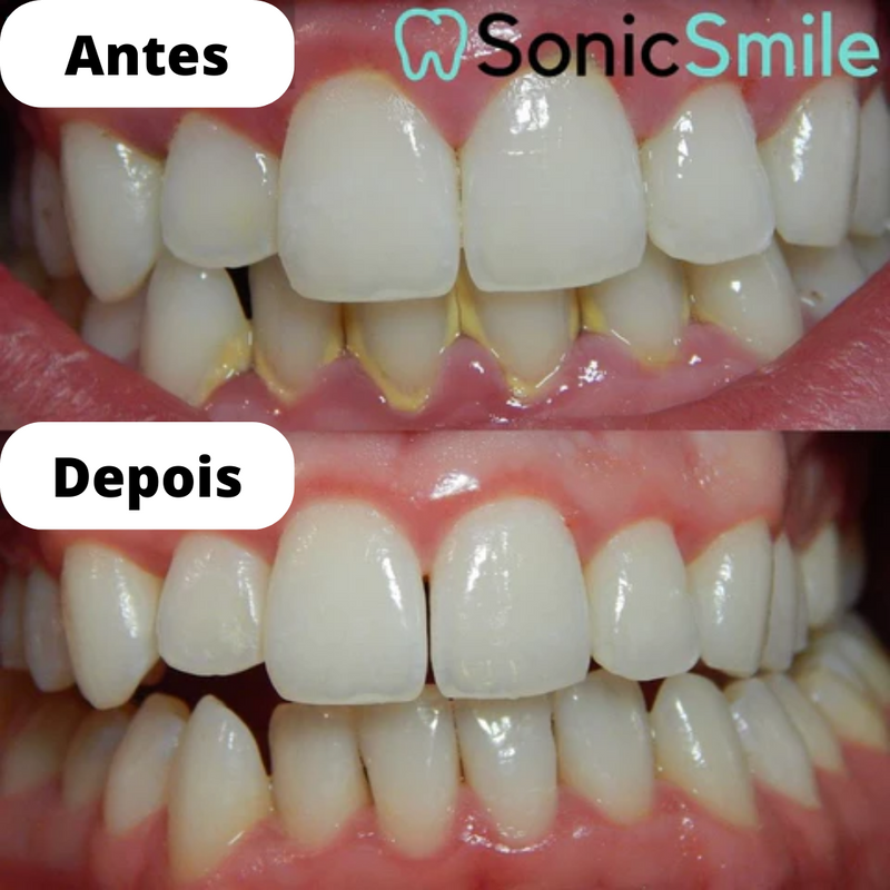 Mais Vendido Limpador de Dentes Ultrassônico Remove Placas e Manchas em Casa - SonicSmile™